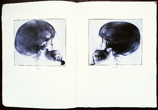 GOLL, Claire & Ivan - Pomes de la vie et de la mort. Avec deux radiographies.